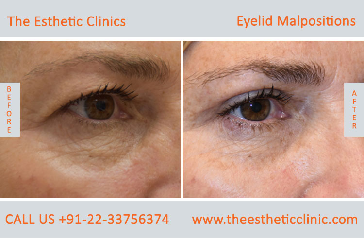 Eyelid Malpostions, Ectropion Entropion Surgery before after photos in mumbai india (1)